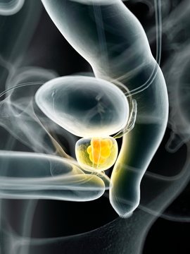 Human prostate cancer, illustration