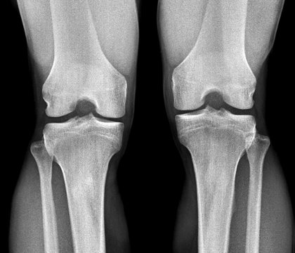 Normal knees, X-rays