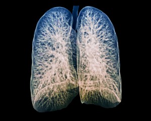 Healthy lungs, CT scan