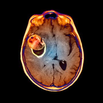 Aneurysm, CT scan