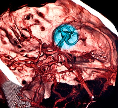 Brain haemorrhage, 3D angiogram