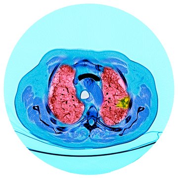 Lung cancer, CT scan