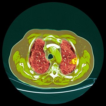 Lung cancer, CT scan