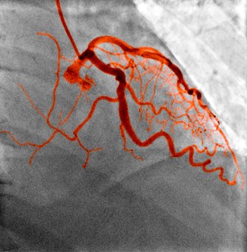 Normal blood vessels, X-ray