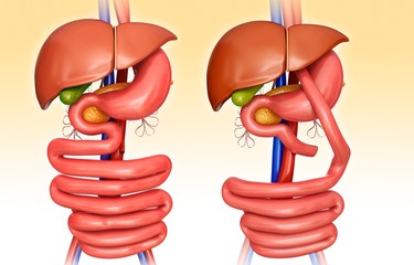Gastric bypass, illustration