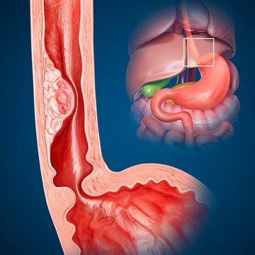 Oesophageal cancer, illustration