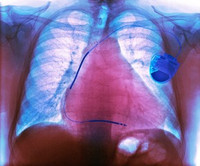 Pacemaker in heart disease, X-ray