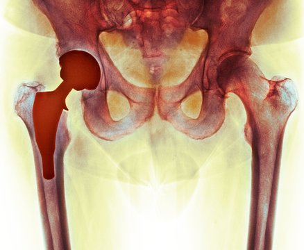 Total hip replacement, X-ray
