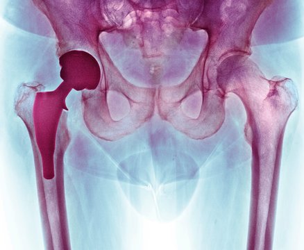 Total hip replacement, X-ray