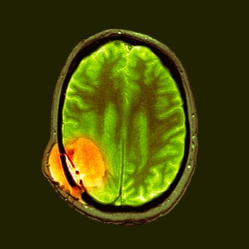 Brain cancer after surgery, MRI scan