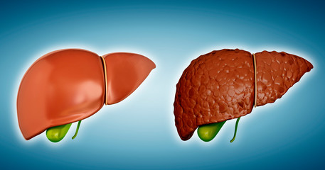 Liver cirrhosis, illustration