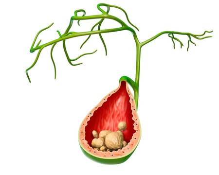 Gall stones, illustration