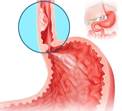 Oesophageal cancer, illustration