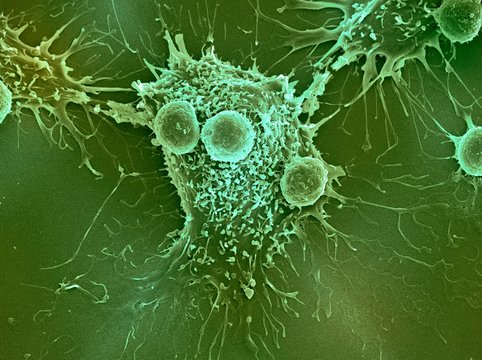 Cancer cell and T lymphocytes, SEM