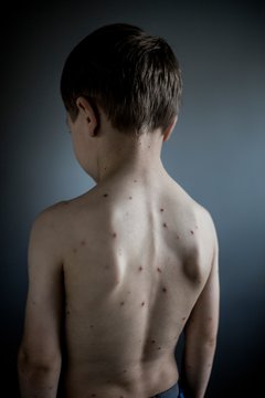 Boy with chickenpox