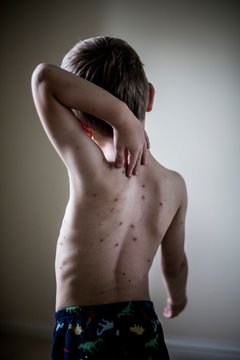 Boy with chickenpox
