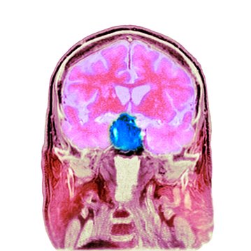 Pituitary tumour, CT scan