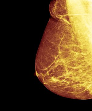 Breast cancer screening, X-ray