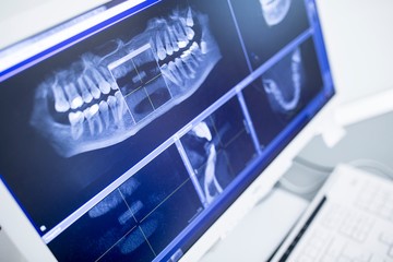 Teeth x-ray