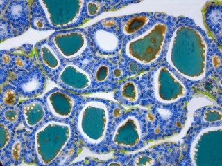 Thyroid, LM