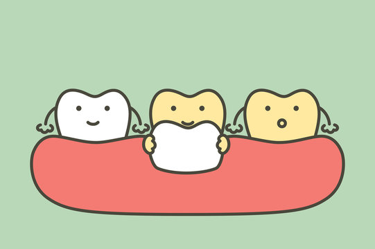 dental veneers installation procedure for tooth whiten - teeth cartoon vector flat style
