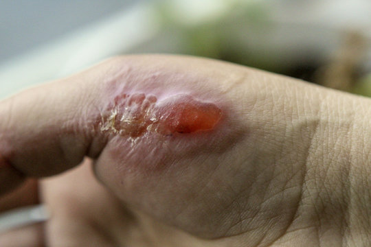Burns on a woman's hand from boiling vegetable oil