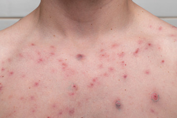 acne on a males chest. result of using steroids and anabolics