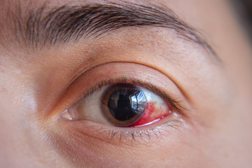 Hemorrhage in the eye of a girl. Abrasion of the cornea. Macro.