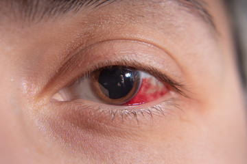 Hemorrhage in the eye of a girl. Abrasion of the cornea. Macro.