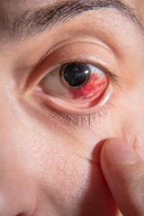Fototapeta premium Hemorrhage in the eye of a girl. Abrasion of the cornea. Macro.