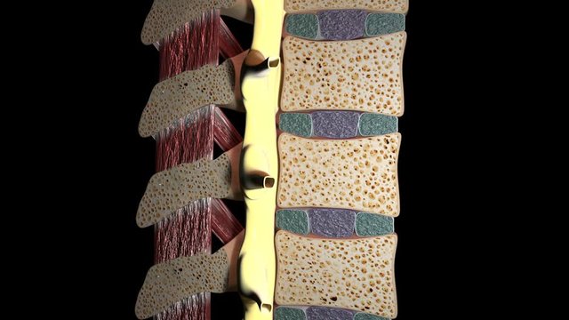 Herniated Disc Section View