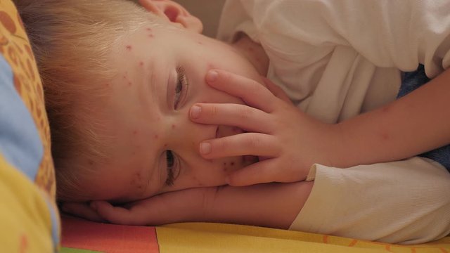 A little sad boy with chickenpox is lying on a bed at home. The child has a lot of blisters and smallpox from chickenpox on the skin.