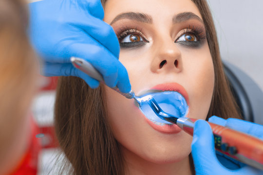 Dental restoration in dentistry with a photopolymer lamp. The girl at the dentist's appointment. Close-up of the oral cavity