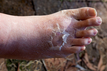 Cellulitis on leg and foot of mature diabetic man in daylight outdoors