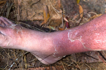 Cellulitis on leg and foot of mature diabetic man in daylight outdoors