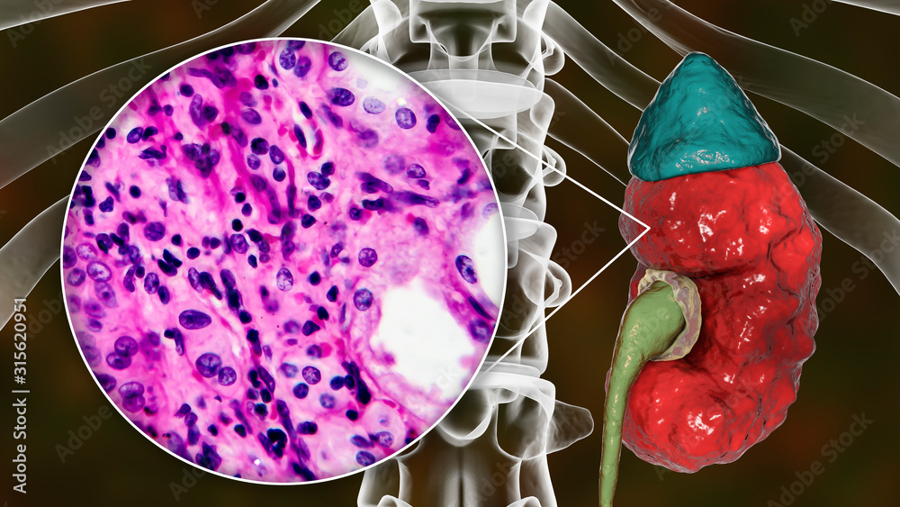 Sticker chronic pyelonephritis, illustration and light micrograph