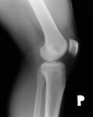 Preventive and control medical examination. X-ray of the right man's knee. Side view.