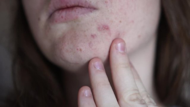 Girl with Skin Problems, Close-up of a woman's face. The girl touches skin with enlarged pores, acnes, examining it. The concept of caring for problem skin, aging, teenage.