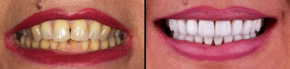 beautiful smile created by press ceramic veneers