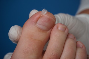 Podiatry, Chiropodist, medical foot care, podiatrist, ingrown toenail, fix an ingrown toenail