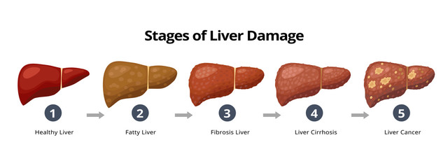 Stages of liver damage from healthy, fatty liver, fibrosis, cirrhosis to liver cancer. Medical infographic, liver diseases icons in flat design isolated on white background.