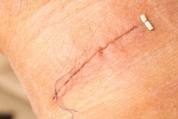 Suture after surgery on the human neck. Stitched wound after surgery. Close up.