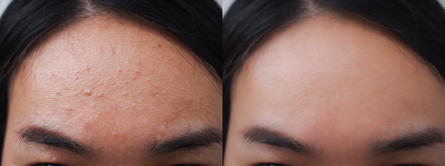 Image before and after acne pimple treatment on the face of young Asian woman.Problem skincare and...