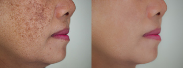 Image before and after dark spot wrinkle melasma pigmentation skin facial treatment on face asian...