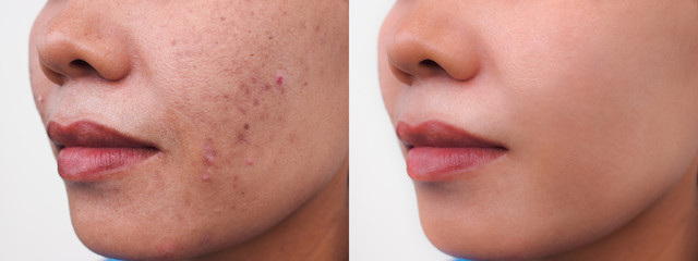 Image before and after dark spots scar acne and melasma pigmentation skin facial treatment on face...