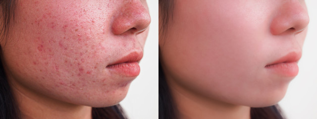 Image before and after spot red scar acne pimples treatment on face asian woman. Problem skincare...