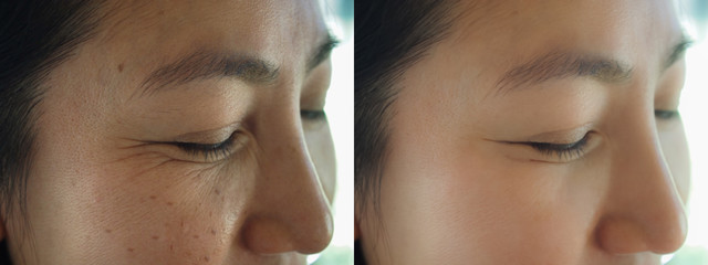 Image before and after treatment rejuvenation surgery on face asian woman concept. Closeup...
