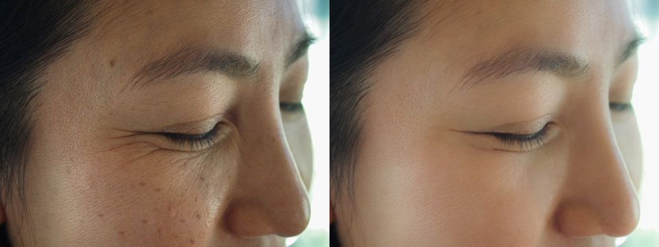 Image before and after treatment rejuvenation surgery on face asian woman concept. Closeup wringkles dark spots freckles pigmentation skin on facial of female.