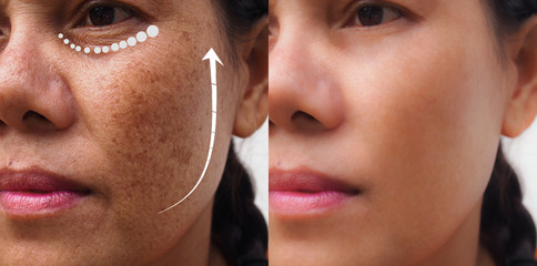 Image before and after anti-aging dark spot melasma pigmentation skin facial treatment rejuvenation of Asian woman .Problem skincare and beauty concept.
