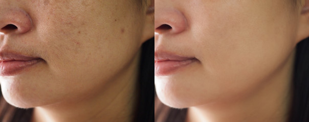 Image before and after spot melasma pigmentation facial treatment on face asian woman.Problem...